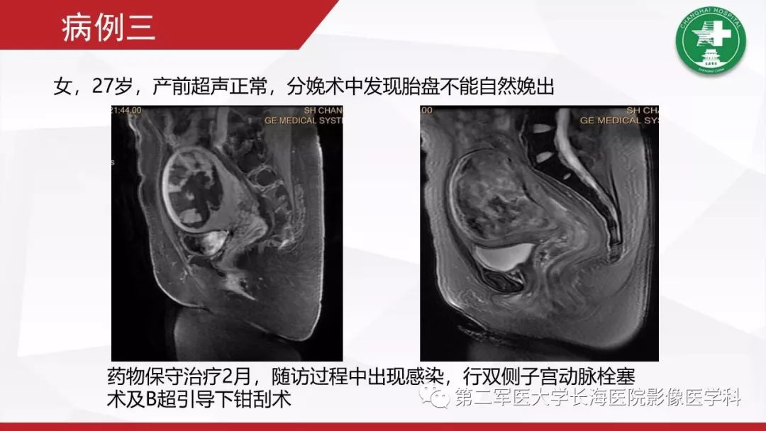 【PPT】胎盘植入的MRI征象