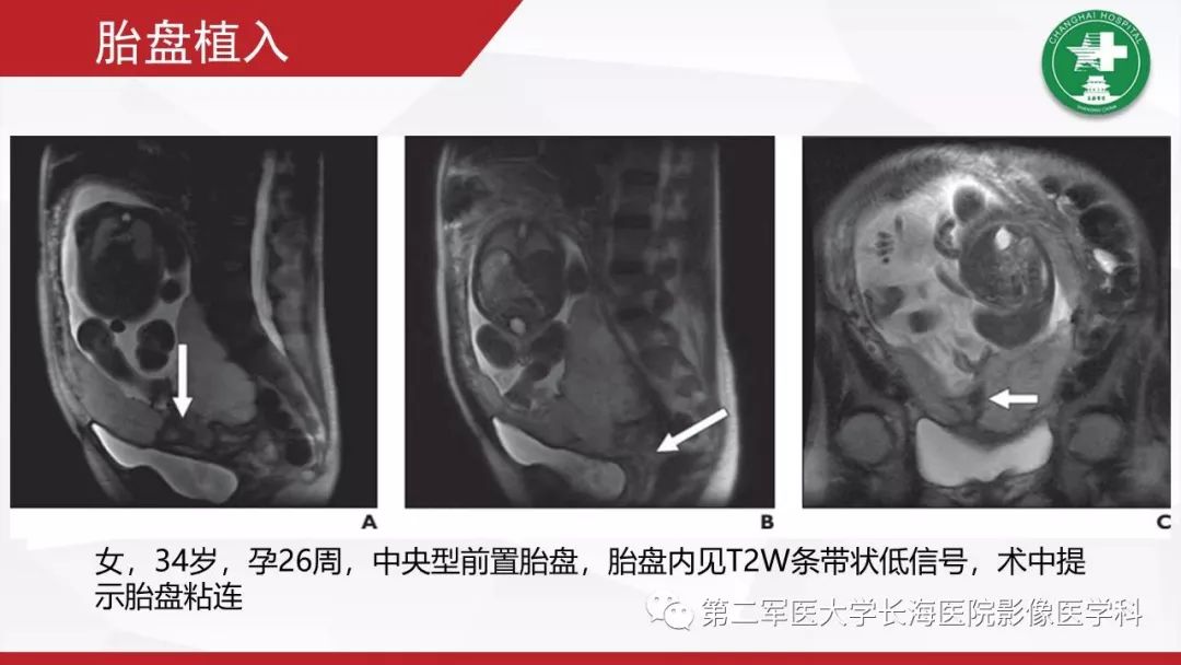 【PPT】胎盘植入的MRI征象
