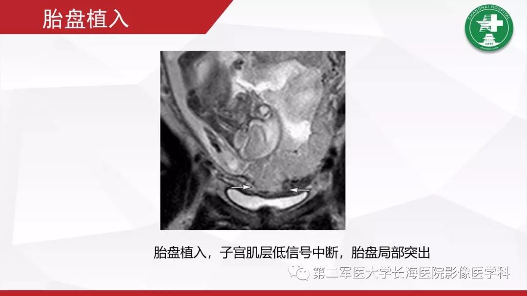 【PPT】胎盘植入的MRI征象