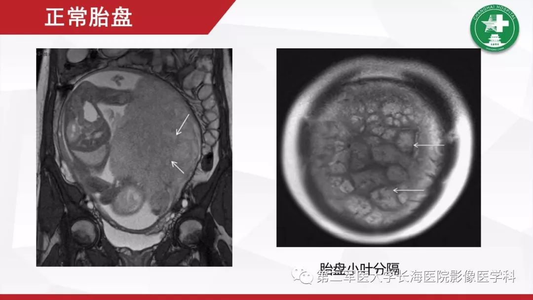 【PPT】胎盘植入的MRI征象