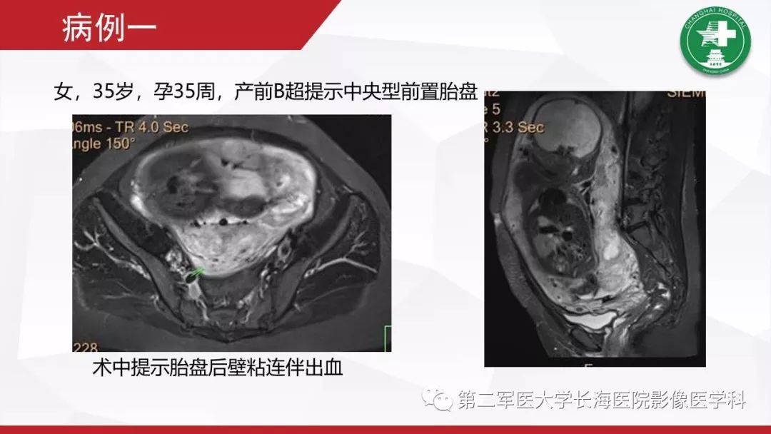 【PPT】胎盘植入的MRI征象
