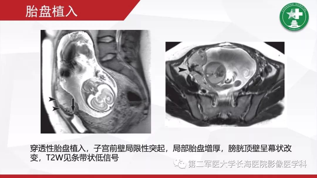【PPT】胎盘植入的MRI征象