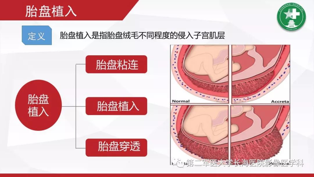 【PPT】胎盘植入的MRI征象