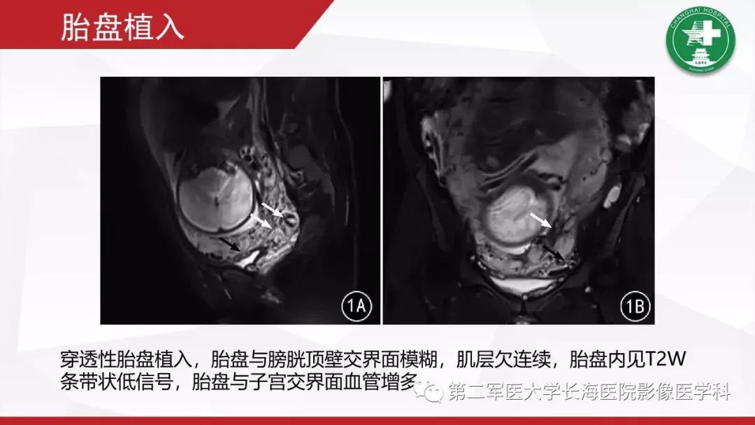 【PPT】胎盘植入的MRI征象