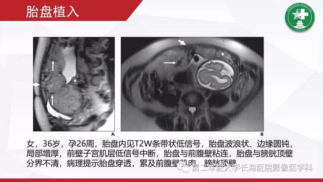【PPT】胎盘植入的MRI征象
