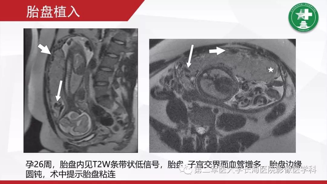 【PPT】胎盘植入的MRI征象