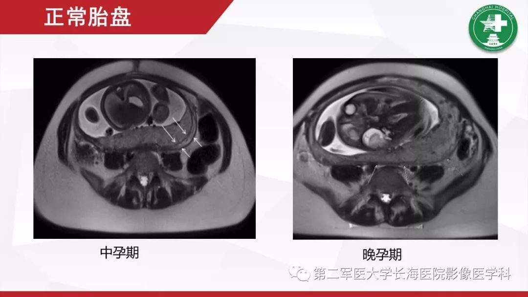 【PPT】胎盘植入的MRI征象