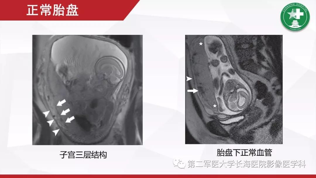 【PPT】胎盘植入的MRI征象
