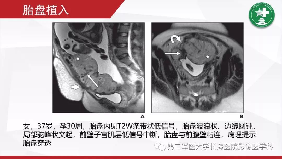 【PPT】胎盘植入的MRI征象