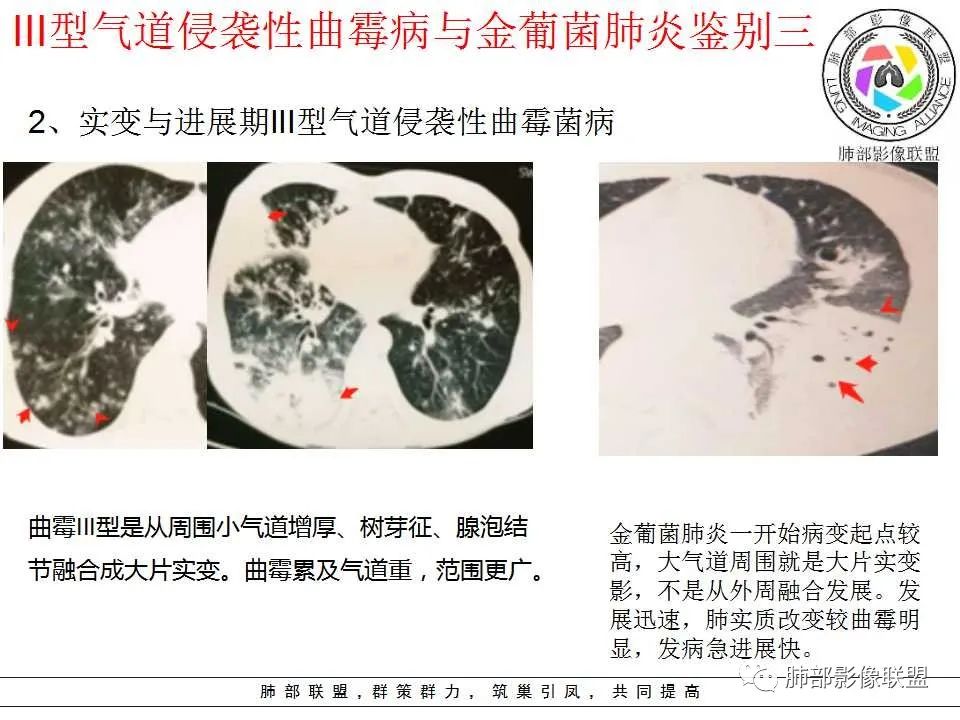【PPT】侵袭性肺曲霉病影像分型及表现