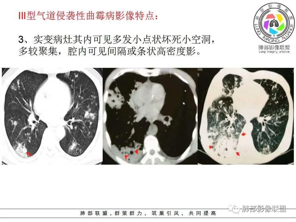 【PPT】侵袭性肺曲霉病影像分型及表现