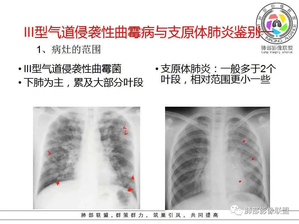 【PPT】侵袭性肺曲霉病影像分型及表现