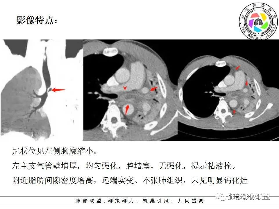 【PPT】侵袭性肺曲霉病影像分型及表现