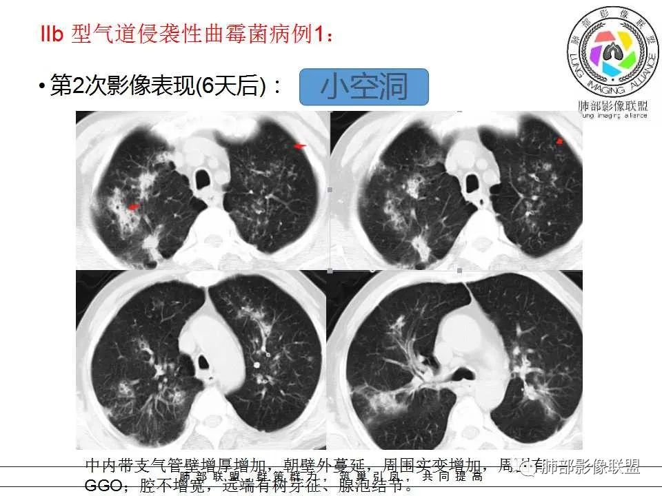 【PPT】侵袭性肺曲霉病影像分型及表现