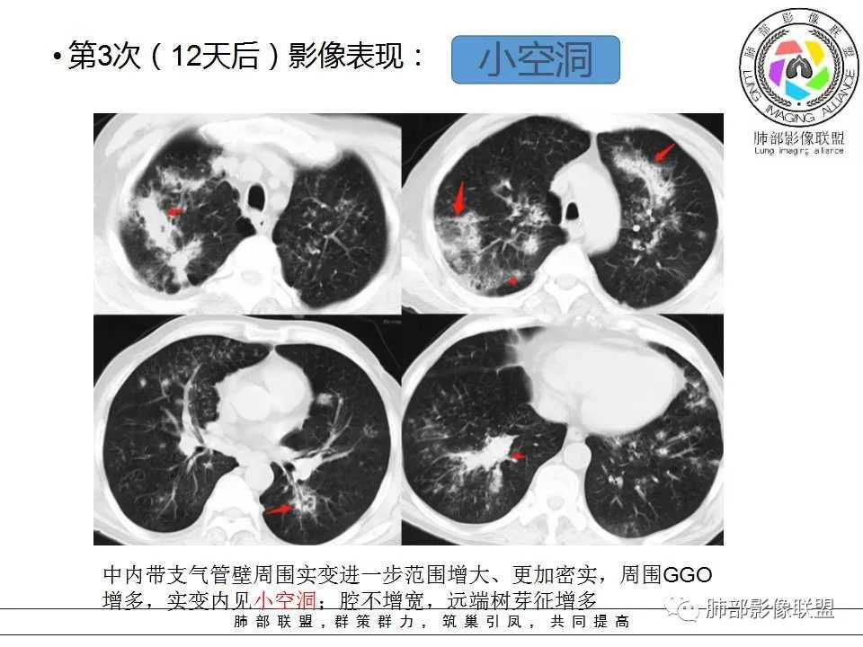 【PPT】侵袭性肺曲霉病影像分型及表现