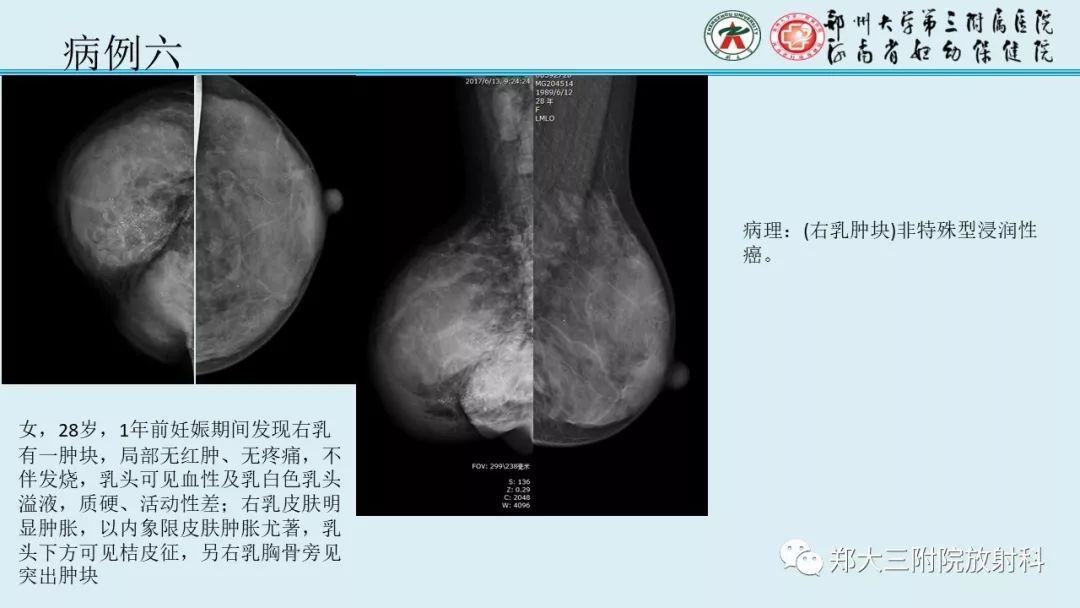 【PPT】妊娠相关乳腺癌的影像诊断