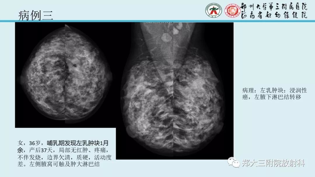 【PPT】妊娠相关乳腺癌的影像诊断