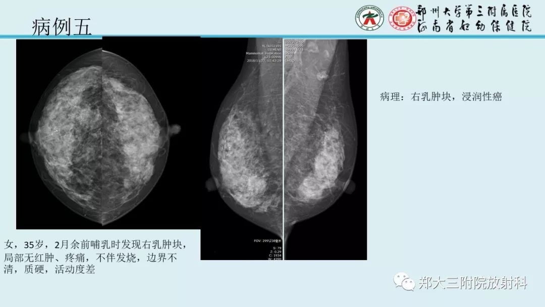 【PPT】妊娠相关乳腺癌的影像诊断