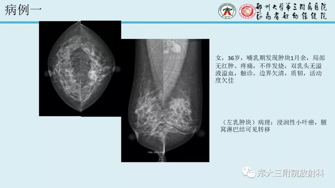 【PPT】妊娠相关乳腺癌的影像诊断
