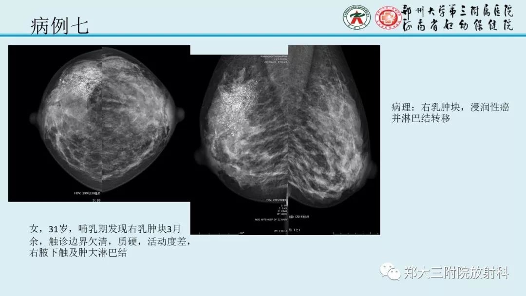 【PPT】妊娠相关乳腺癌的影像诊断