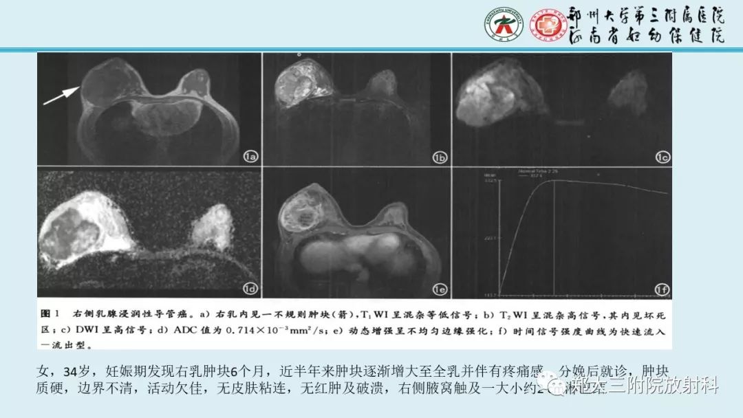【PPT】妊娠相关乳腺癌的影像诊断