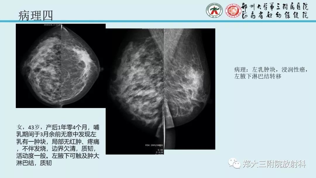 【PPT】妊娠相关乳腺癌的影像诊断