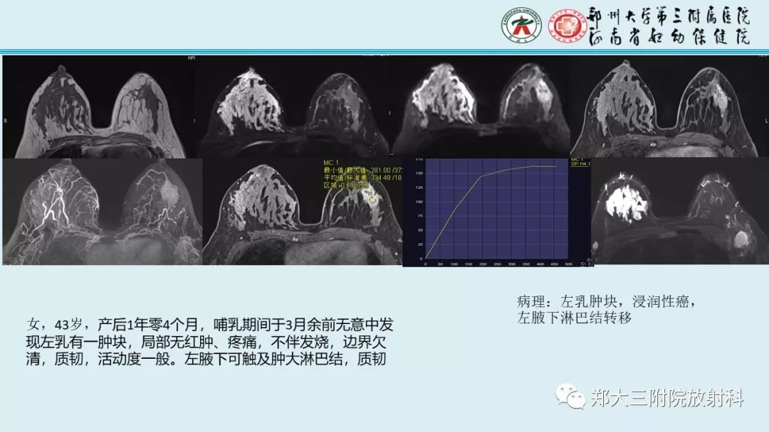 【PPT】妊娠相关乳腺癌的影像诊断