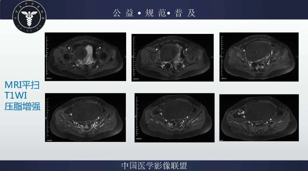 【病例】卵巢低级别浆液性囊腺癌1例CT及MR影像