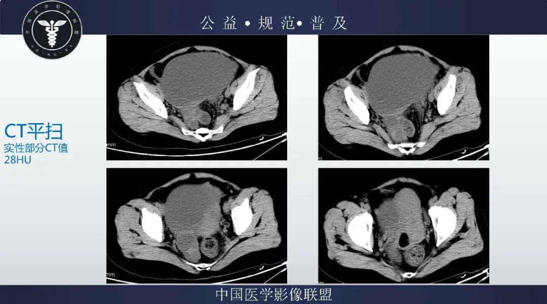 【病例】卵巢低级别浆液性囊腺癌1例CT及MR影像