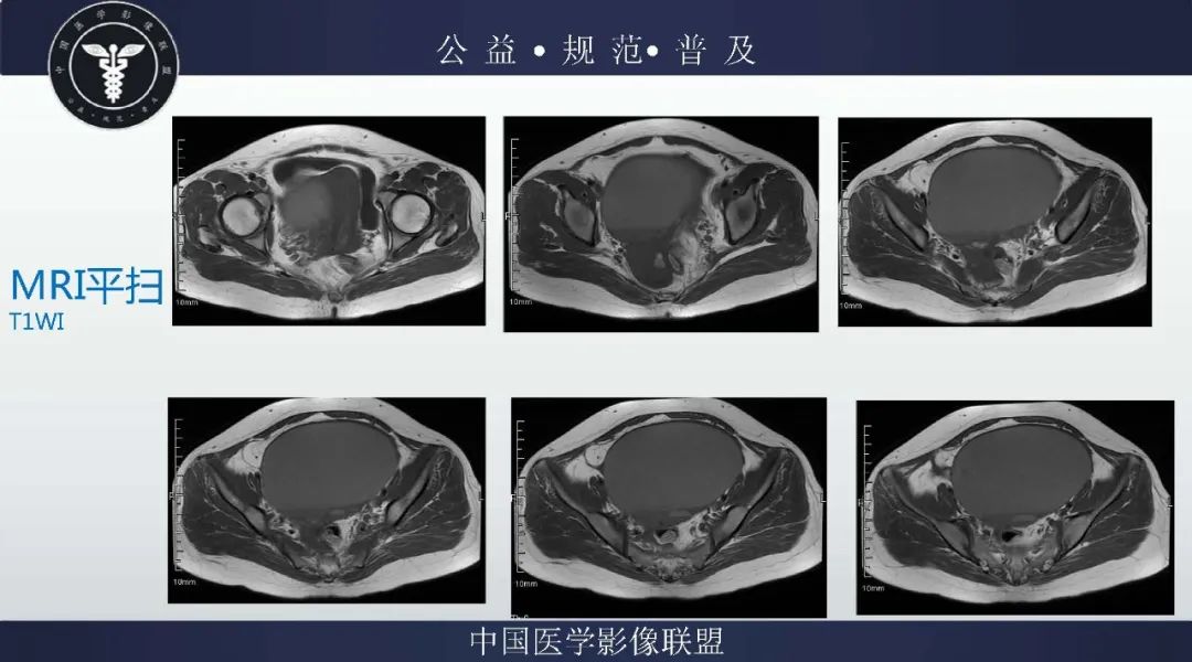 【病例】卵巢低级别浆液性囊腺癌1例CT及MR影像