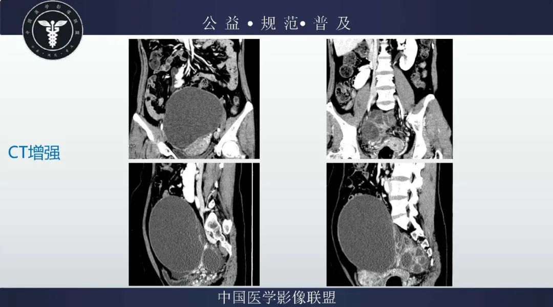 【病例】卵巢低级别浆液性囊腺癌1例CT及MR影像