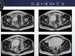 卵巢低级别浆液性囊腺癌1例CT及MR影像