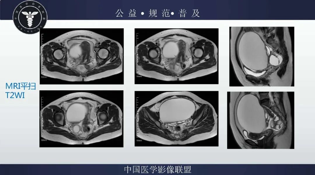 【病例】卵巢低级别浆液性囊腺癌1例CT及MR影像