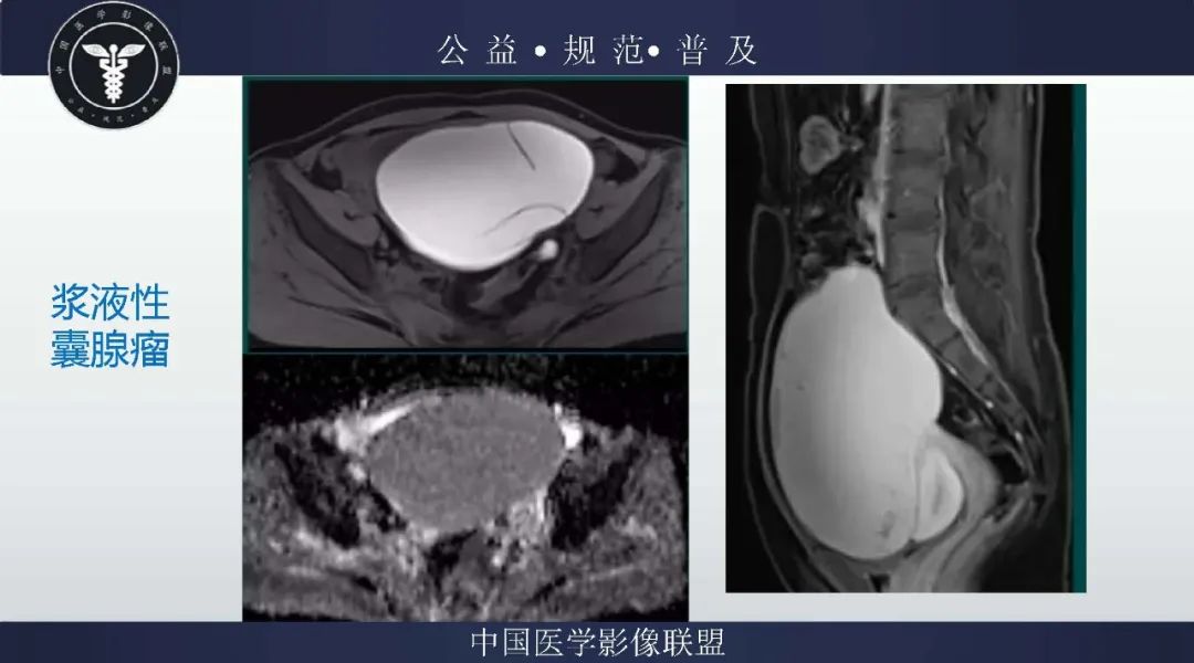 【病例】卵巢低级别浆液性囊腺癌1例CT及MR影像