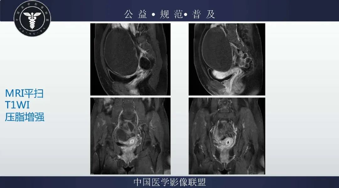 【病例】卵巢低级别浆液性囊腺癌1例CT及MR影像