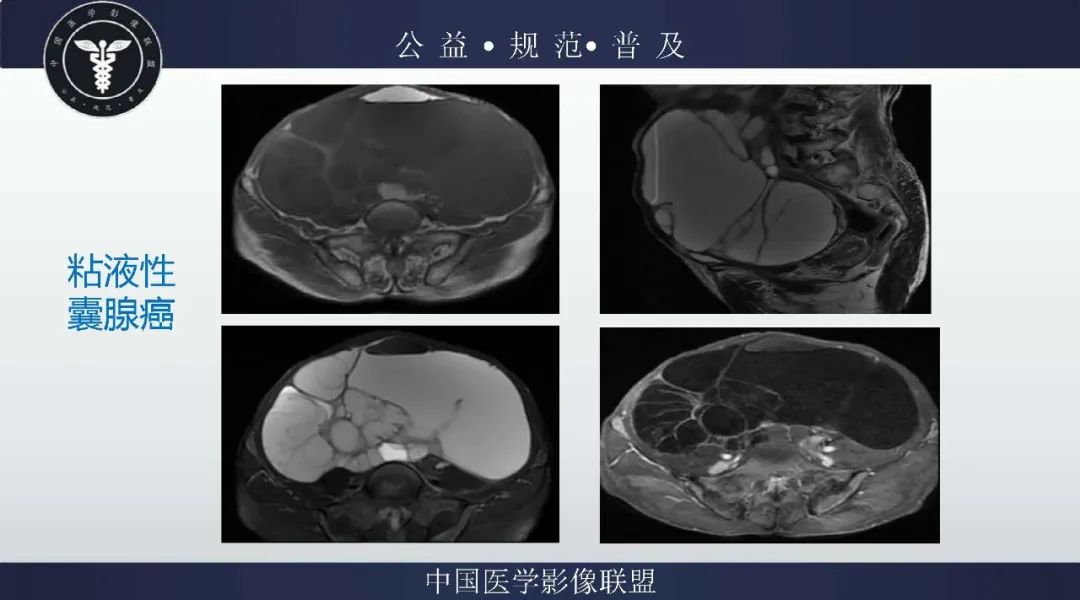 【病例】卵巢低级别浆液性囊腺癌1例CT及MR影像