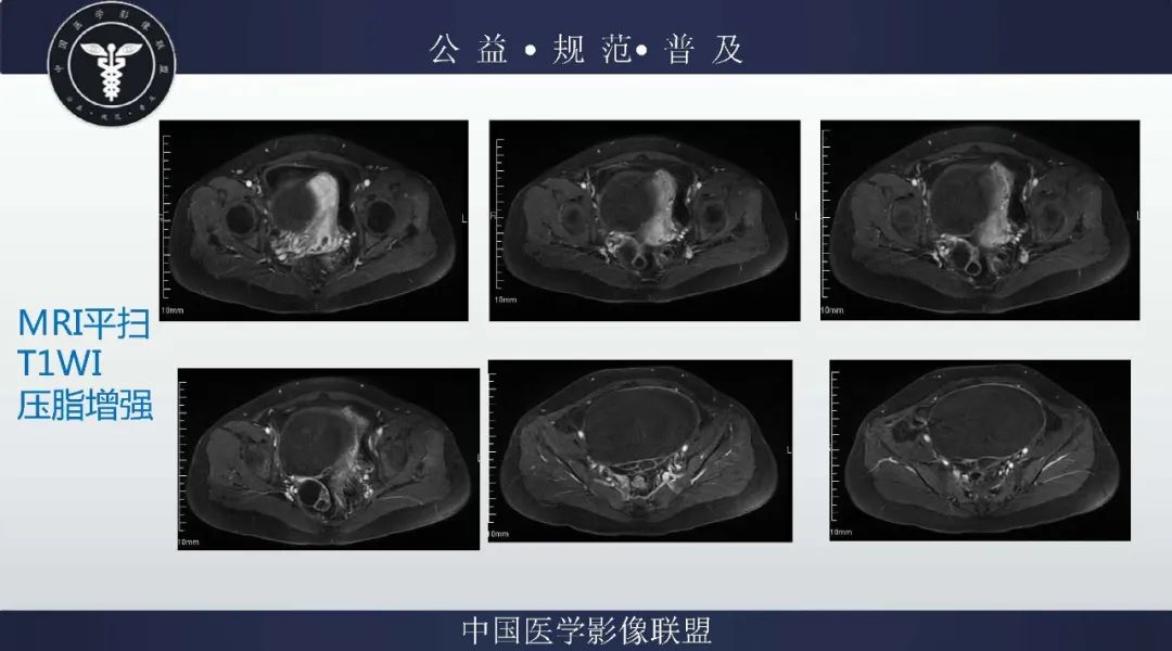 【病例】卵巢低级别浆液性囊腺癌1例CT及MR影像