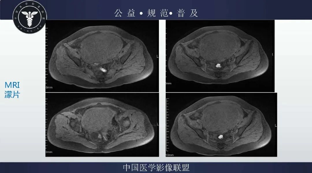 【病例】卵巢低级别浆液性囊腺癌1例CT及MR影像