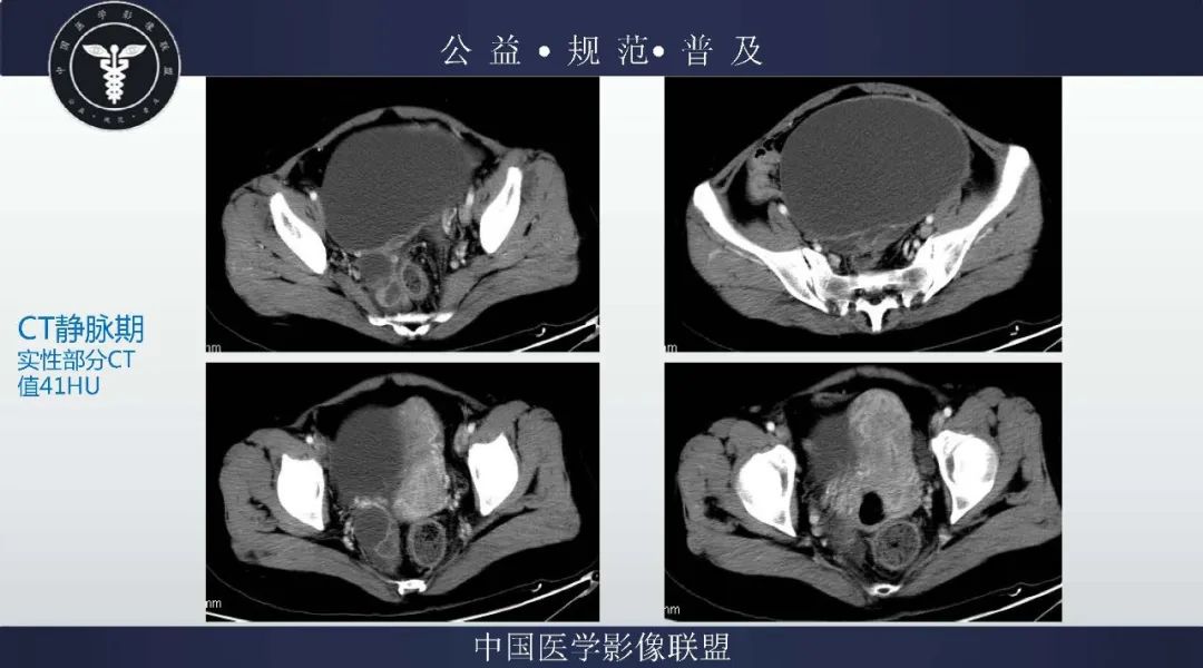 【病例】卵巢低级别浆液性囊腺癌1例CT及MR影像