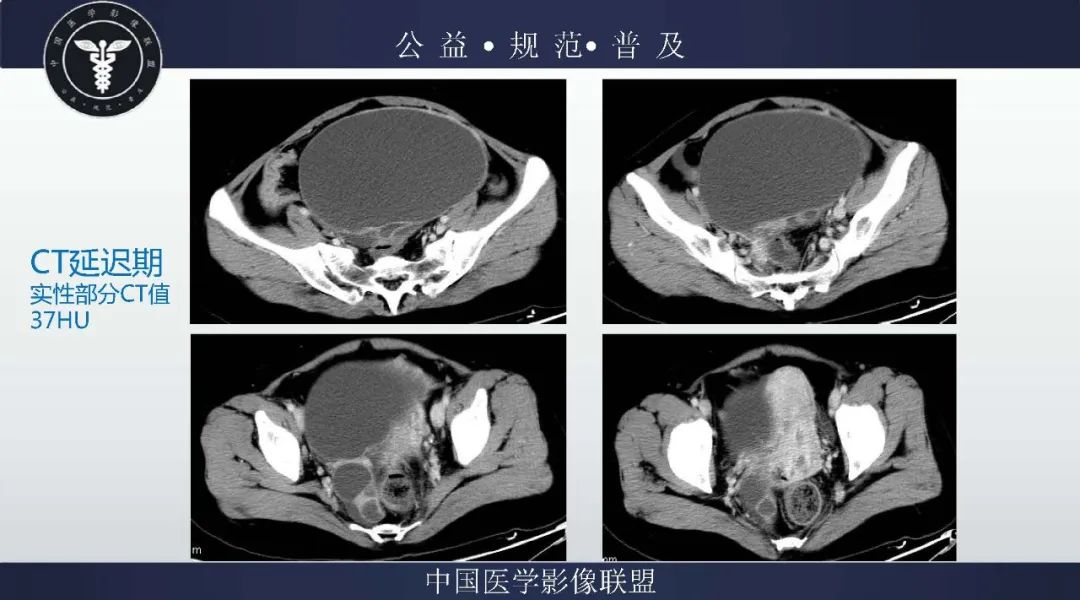 【病例】卵巢低级别浆液性囊腺癌1例CT及MR影像