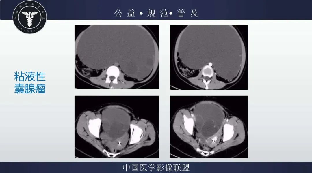 【病例】卵巢低级别浆液性囊腺癌1例CT及MR影像