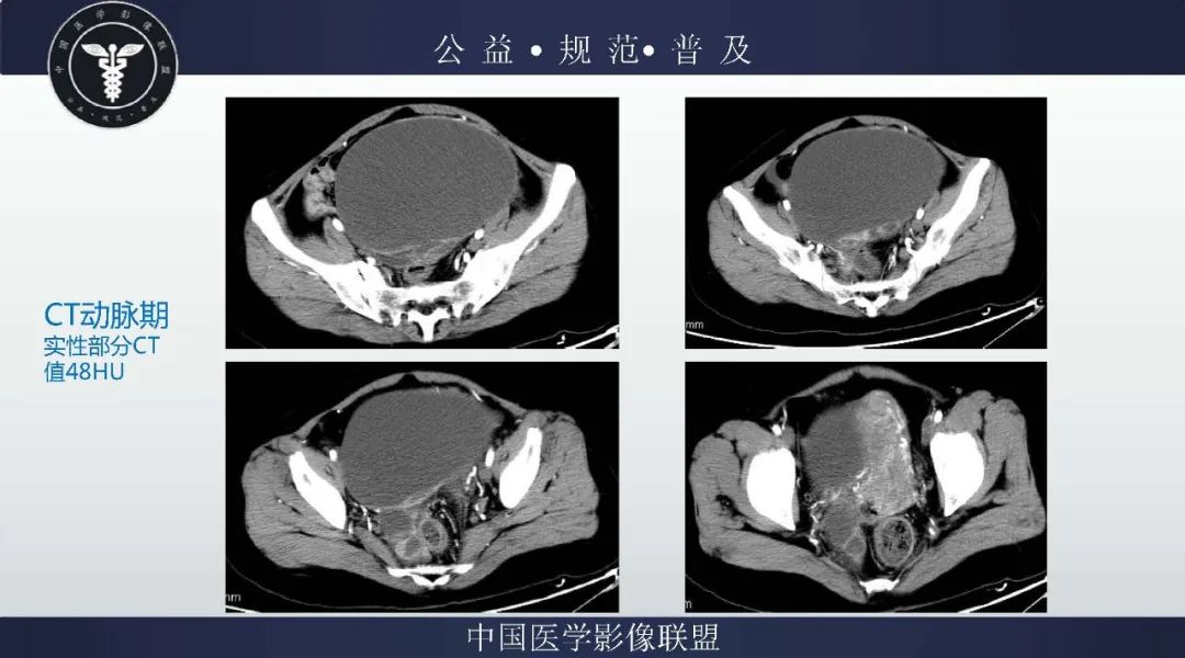 【病例】卵巢低级别浆液性囊腺癌1例CT及MR影像