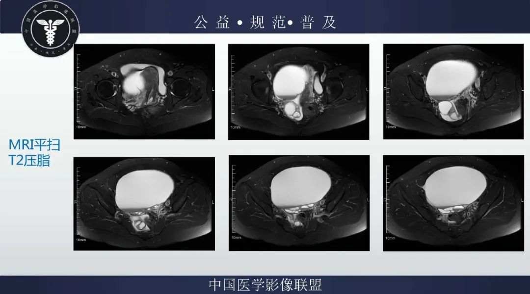 【病例】卵巢低级别浆液性囊腺癌1例CT及MR影像