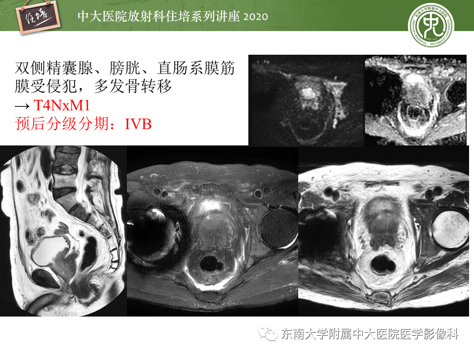 【PPT】MRI在前列腺癌TNM分期中的应用