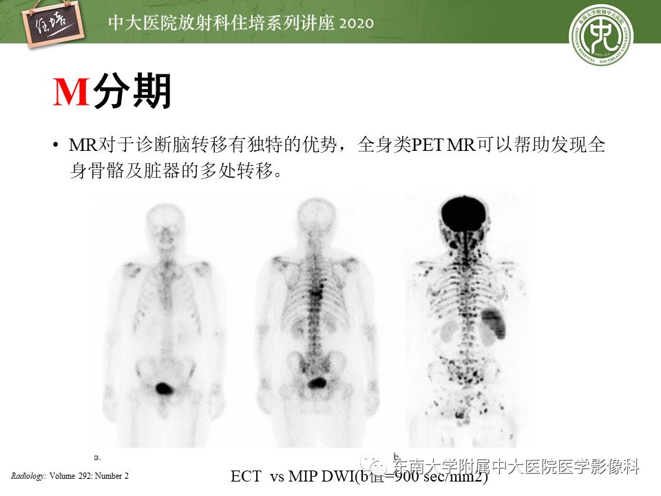 【PPT】MRI在前列腺癌TNM分期中的应用