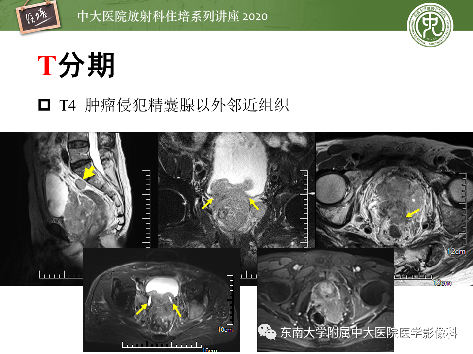 【PPT】MRI在前列腺癌TNM分期中的应用