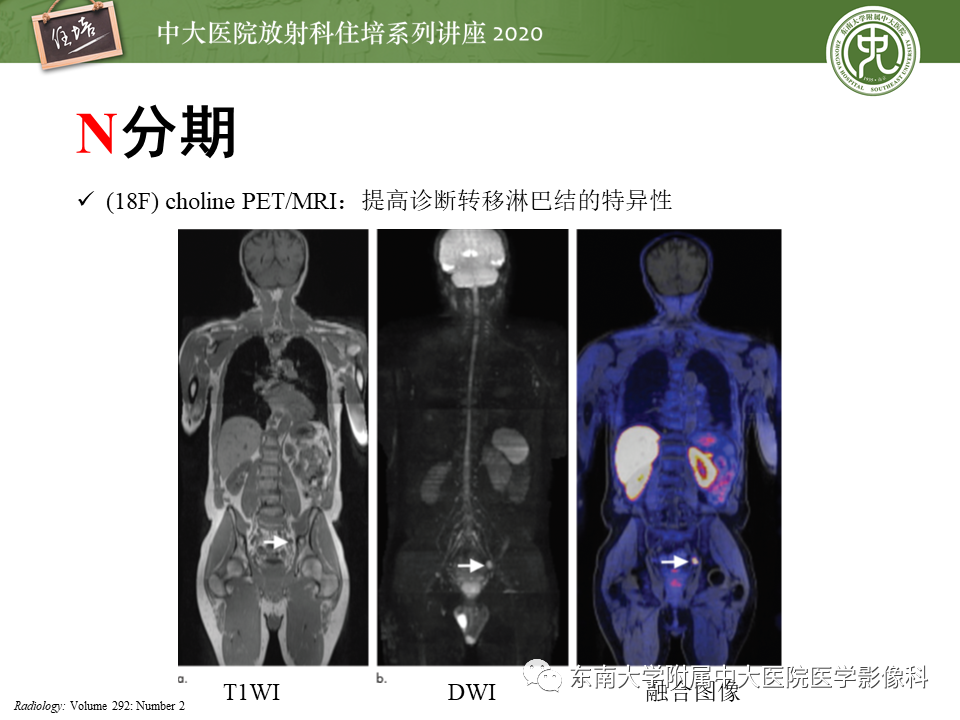 【PPT】MRI在前列腺癌TNM分期中的应用