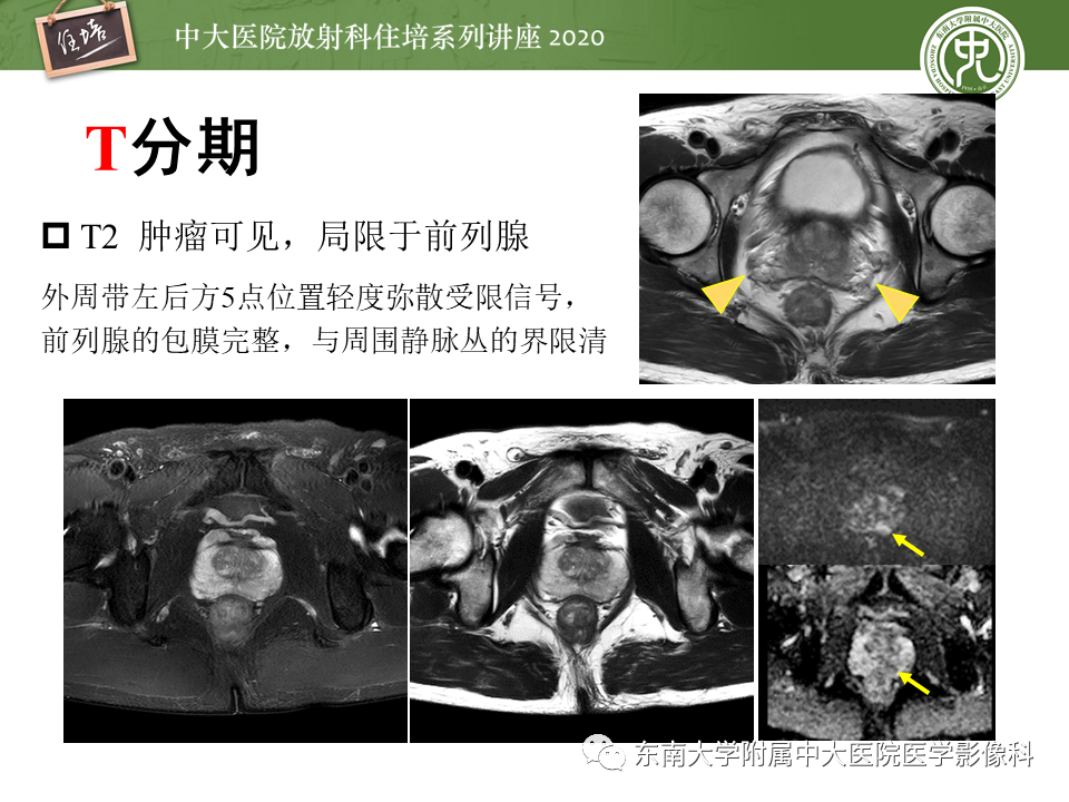 【PPT】MRI在前列腺癌TNM分期中的应用