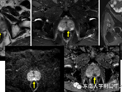 MRI在前列腺癌TNM分期中的应用