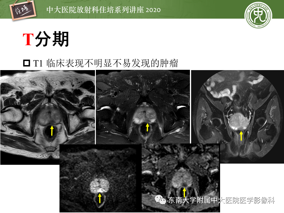 【PPT】MRI在前列腺癌TNM分期中的应用